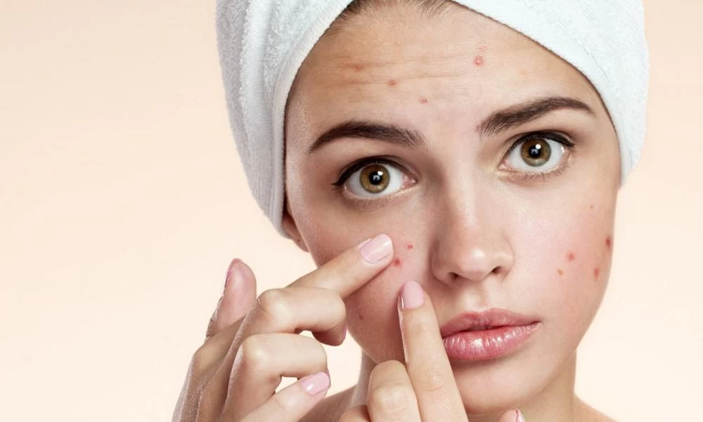 Ακμή στα 30: Δείτε σε τι μπορεί να οφείλεται και τι την προκαλεί